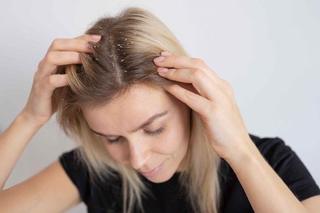 how to prevent hair dandruff